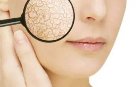 Kuru Cilt Nedir? Kuru Cilt Nasıl Geçer? Evde Kuru Cilt Tedavisi