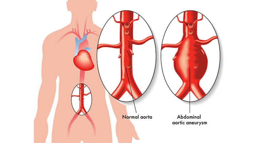 Abdominal Aort Anevrizması Nedir? Belirtileri, Nedenleri, Teşhis ve Tedavi Yöntemleri