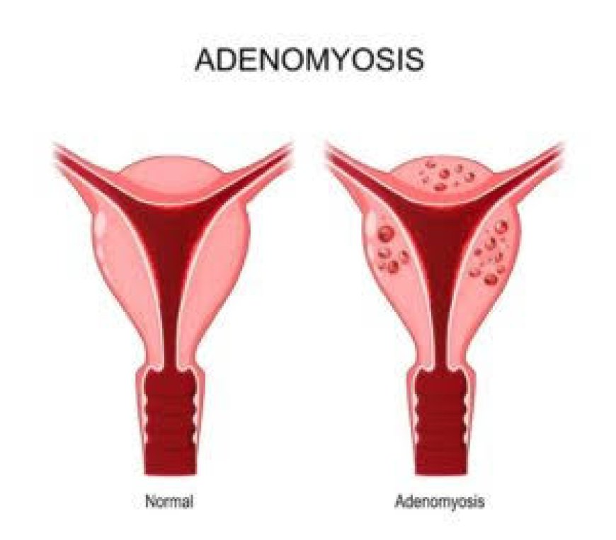 Adenomyozis Nedir? Belirtileri, Teşhisi ve Tedavi Yöntemleri