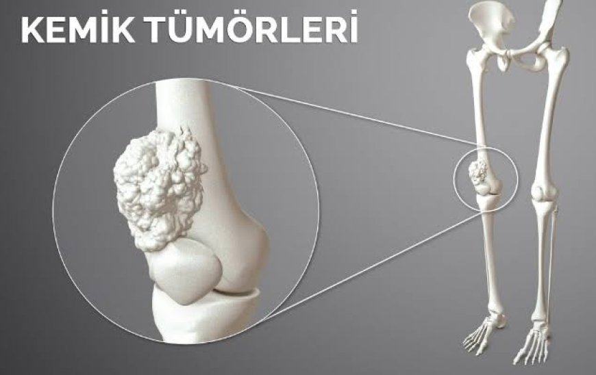 Anevrizmal Kemik Kisti Nedir? Nedenleri, Belirtileri ve Tedavi Yöntemleri