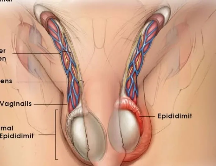 Epididimit (Meni Kanalı İltihabı) Nedir? Belirtileri, Nedenleri ve Tedavi Yöntemleri