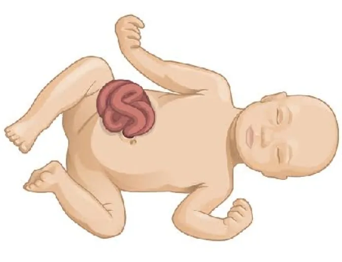 Gastroşizis Nedir? Belirtileri, Nedenleri, Teşhis ve Tedavi Yöntemleri